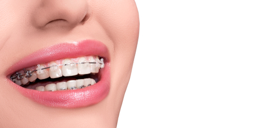 Braces,On,Teeth.,Dental,Braces,Smile.,Orthodontic,Treatment.,Closeup,Smiling