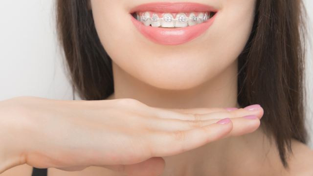Surrey Orthodontist - Self Ligating Braces